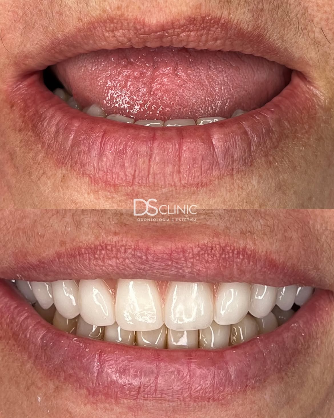 Implante Dentário Custa Caro? Entenda o Valor Real em Eusébio