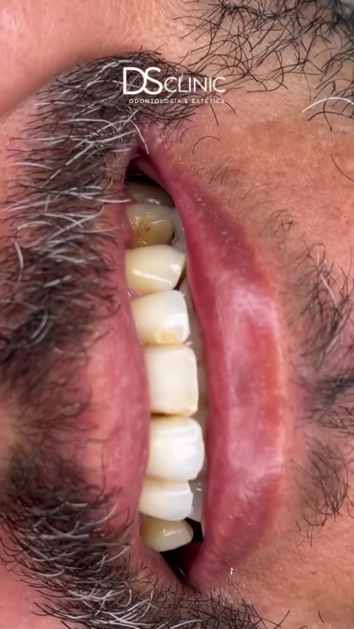 Facetas em Resina no Eusébio: Antes e Depois na DS Clinic