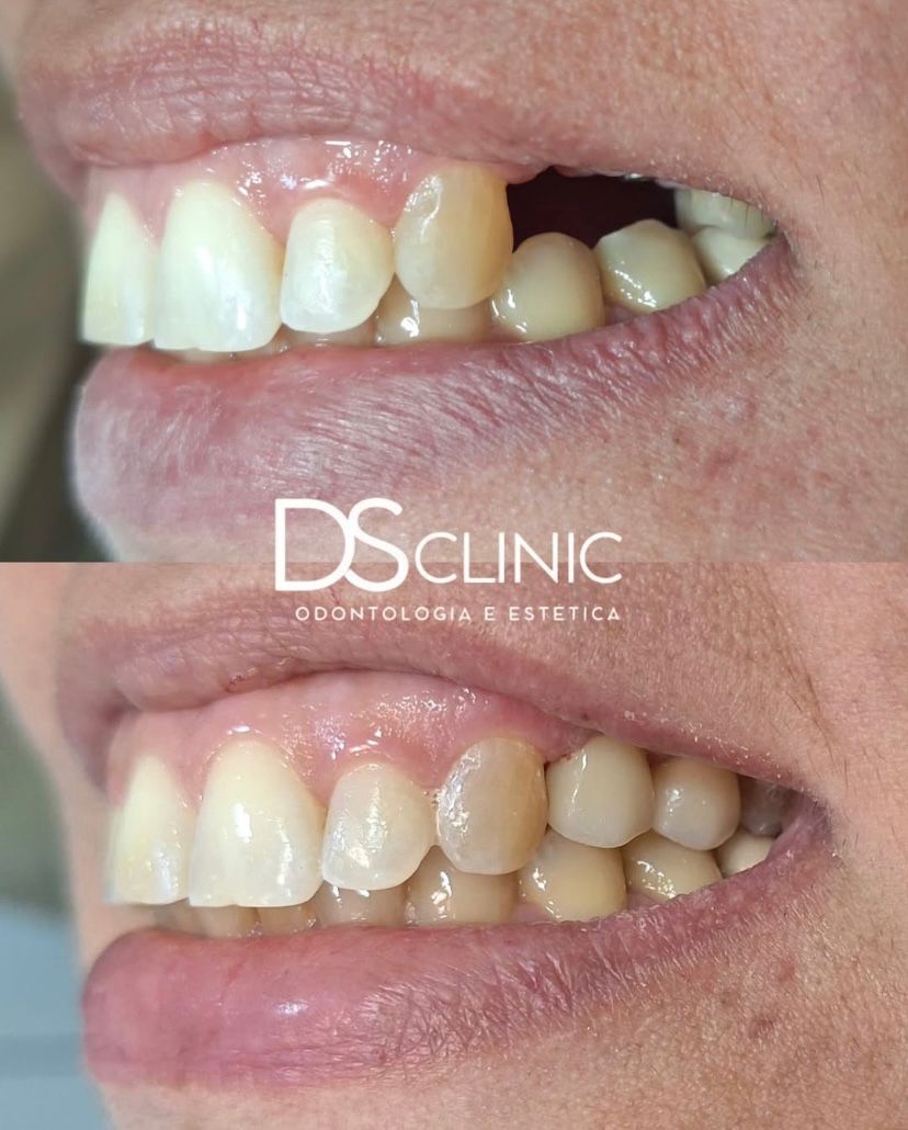 Implante Dentário no Eusébio: Recupere seu Sorriso na DS Clinic