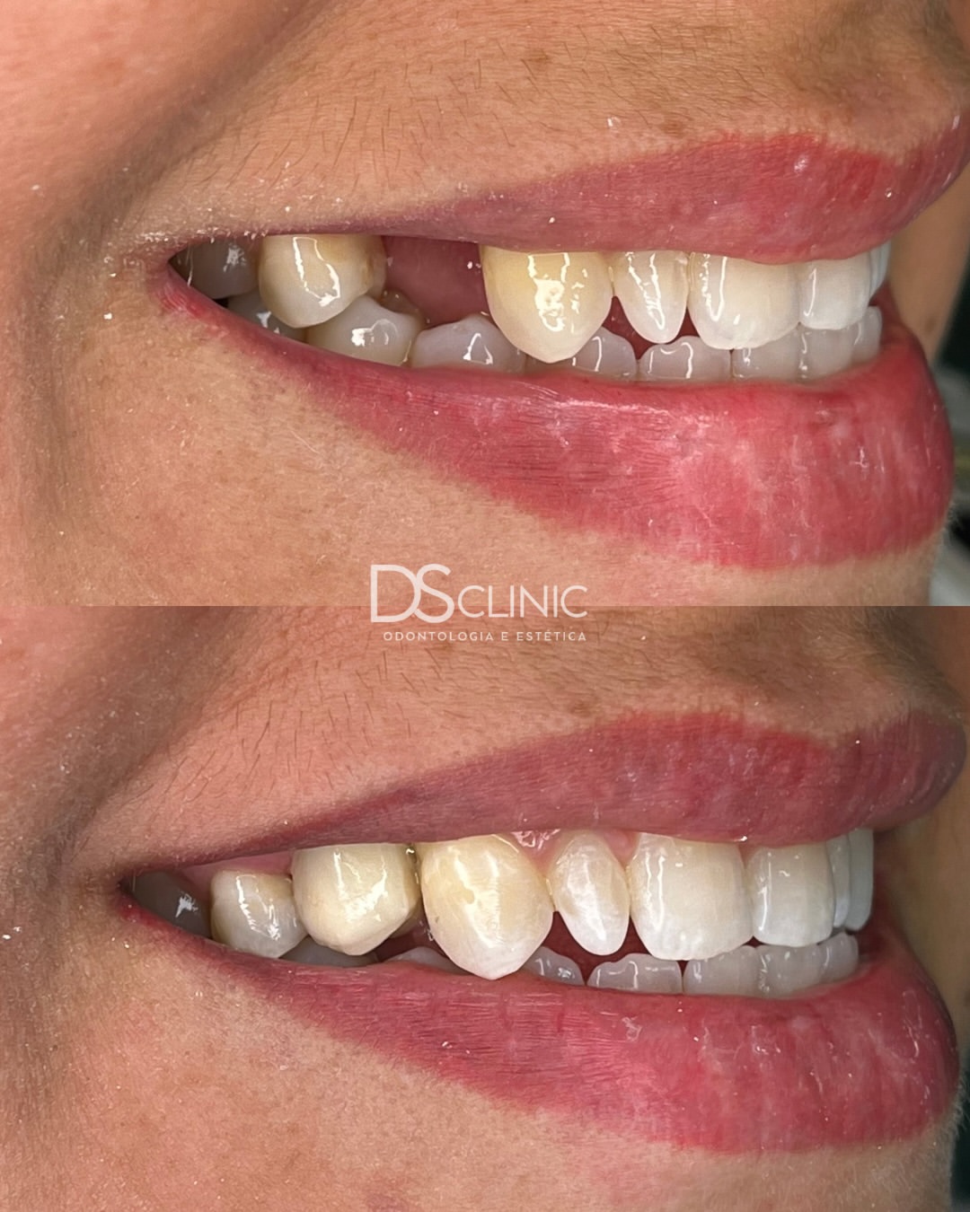 Implante Dentário em Eusébio: Quando o Dente Não Pode Ser Salvo