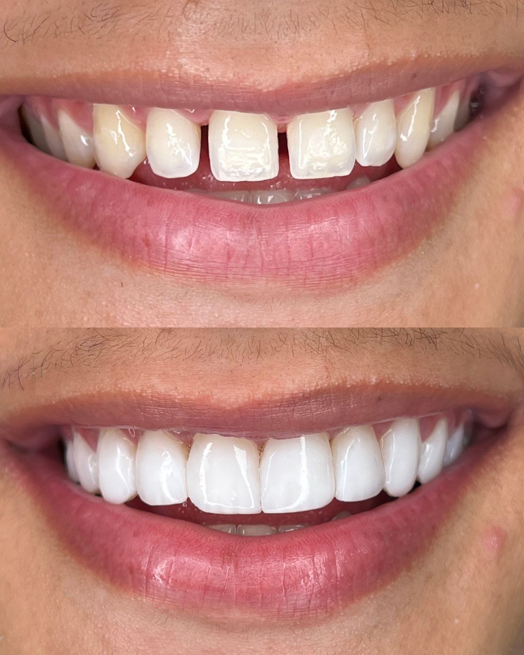 Lentes de contato dental