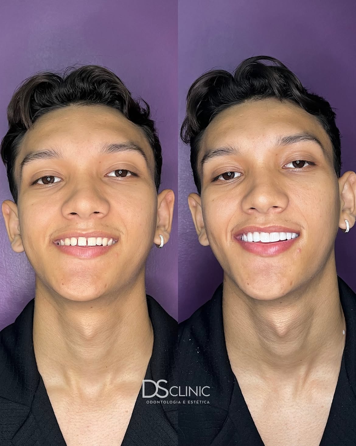 Facetas Eusébio: Como Fechar o Espaço Entre os Dentes Sem Aparelho