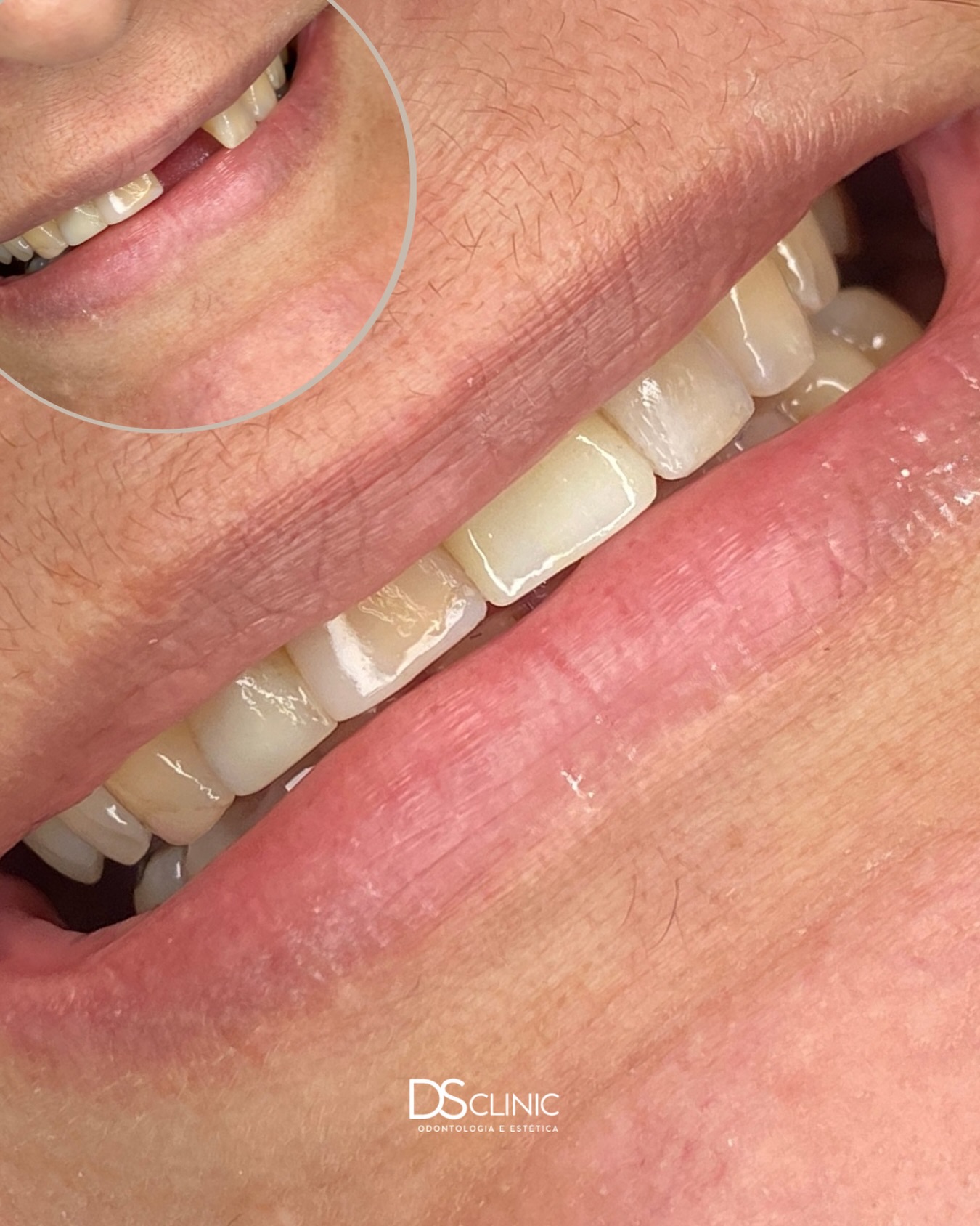 Lentes de contato dental