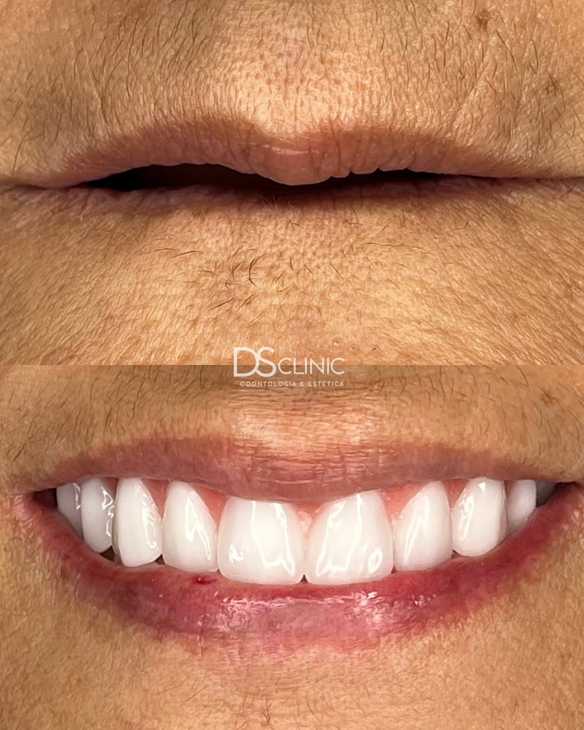 Lentes de contato dental no Eusébio: antes e depois de um sorriso que voltou a viver