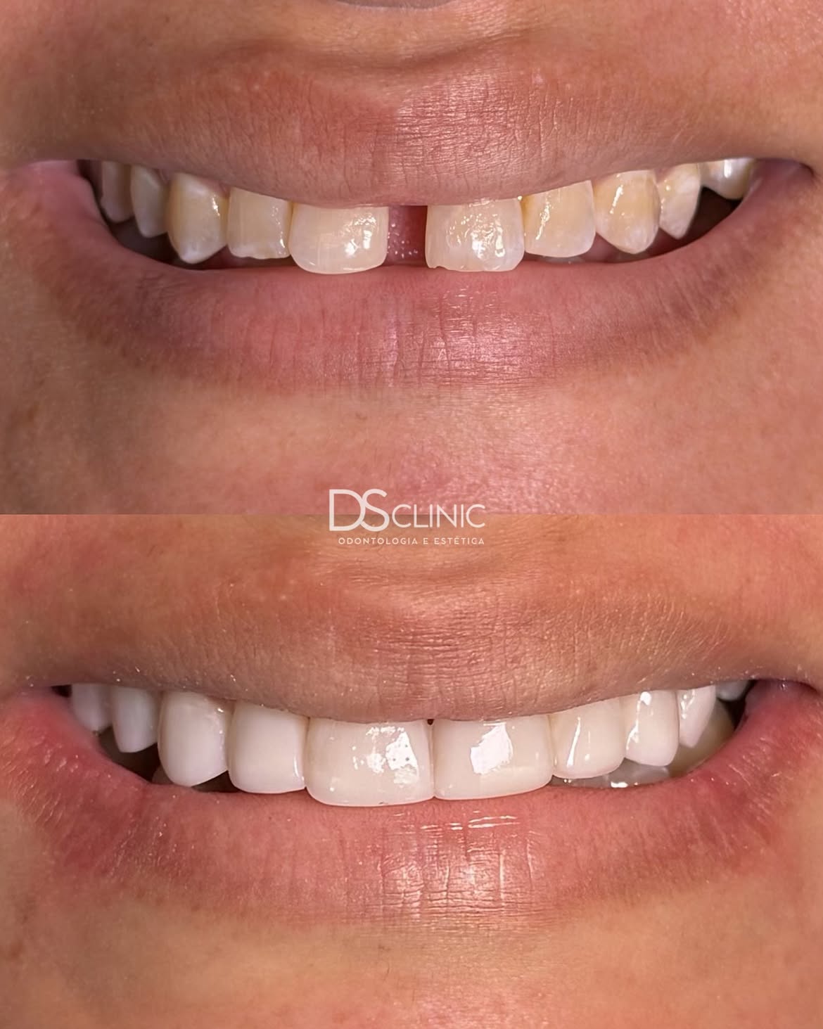 Facetas de resina antes e depois no Eusébio: sorriso natural em poucas sessões